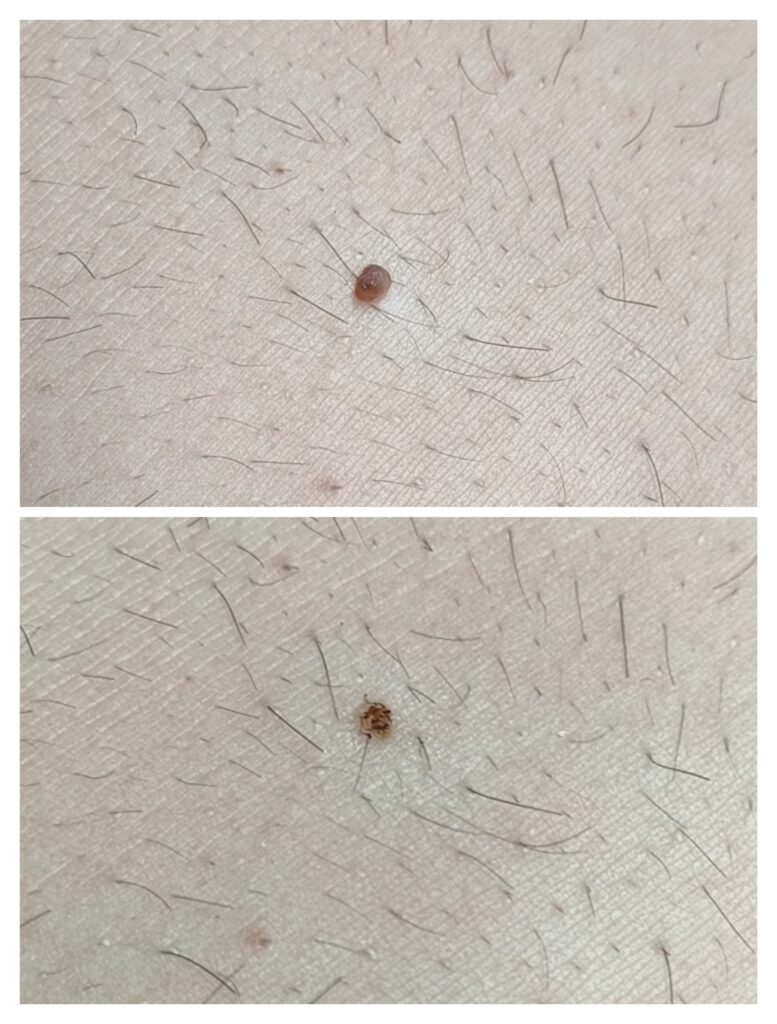 Dokumentacja zabiegu Plasma IQ w MONROE Clinic – zdjęcie 6