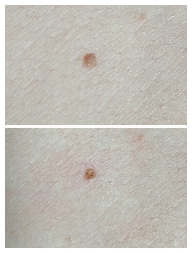 Dokumentacja zabiegu Plasma IQ w MONROE Clinic – zdjęcie 7