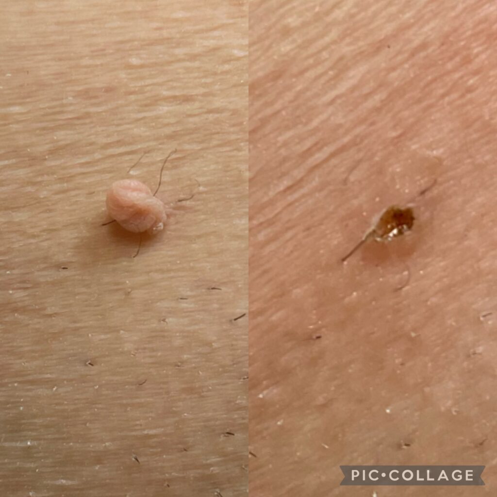 Dokumentacja zabiegu Plasma IQ w MONROE Clinic – zdjęcie 3