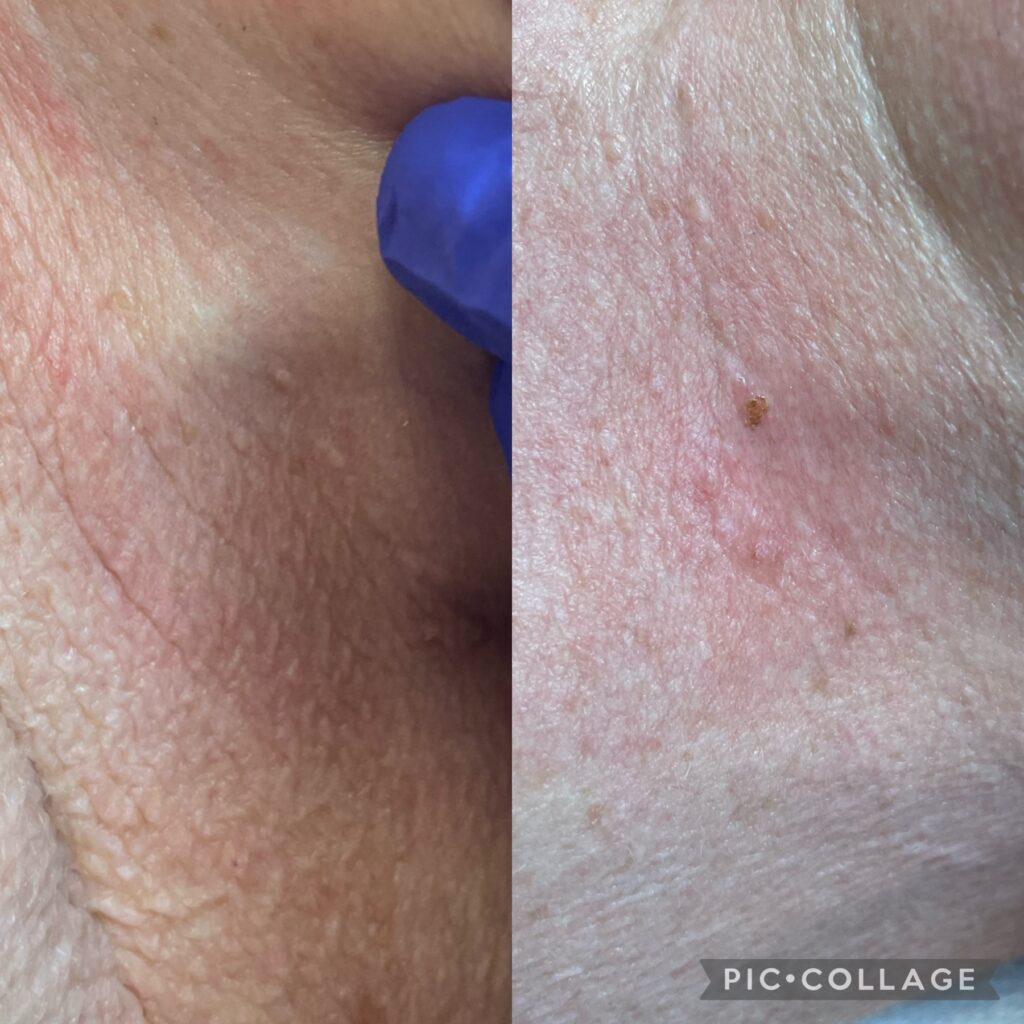 Dokumentacja zabiegu Plasma IQ w MONROE Clinic – zdjęcie 4