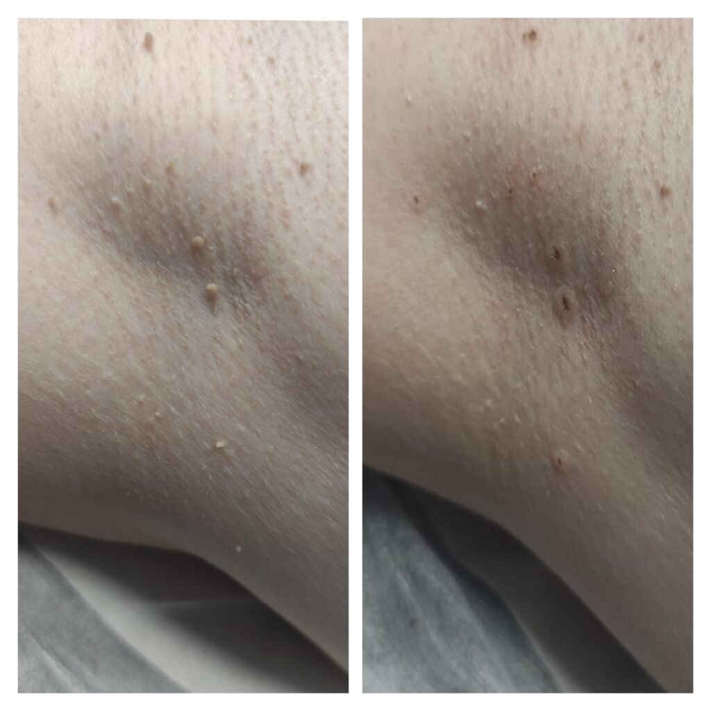 Dokumentacja zabiegu Plasma IQ w MONROE Clinic – zdjęcie 2
