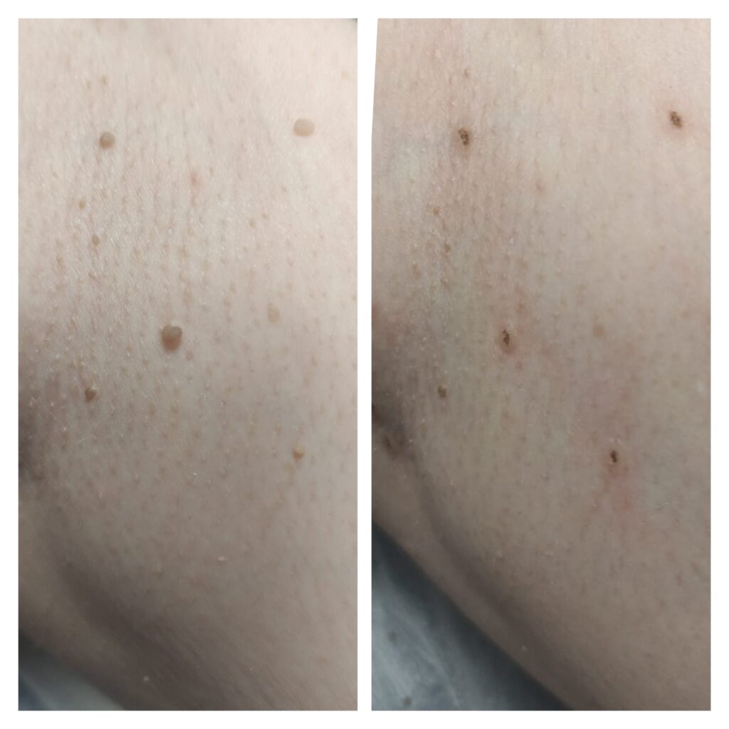 Dokumentacja zabiegu Plasma IQ w MONROE Clinic – zdjęcie 1